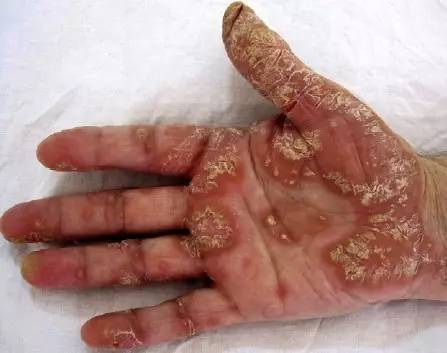 深圳哪家治疗牛皮癣医院好