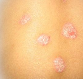 牛皮癣的治疗方法