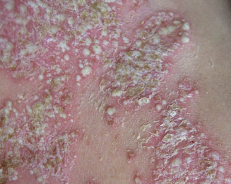 牛皮癣复发忧愁