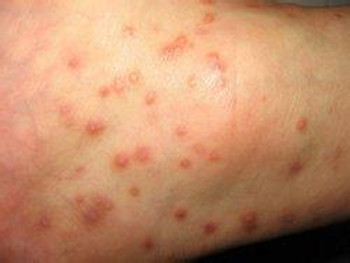 中药可以治疗康复牛皮癣