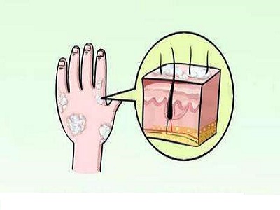 银屑病治疗不好吗